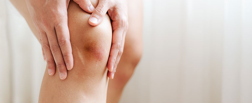 Why Am I Getting So Many Bruises?