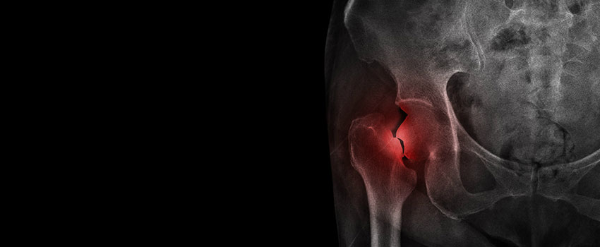 Can a Small Fracture Get Worse?