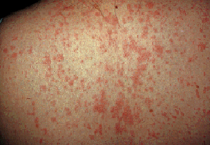 What Are the Symptoms of Measles?