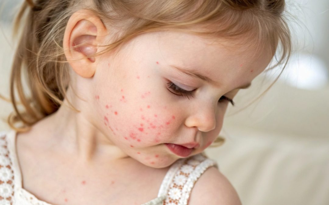 Is Measles Contagious Before the Rash Appears?