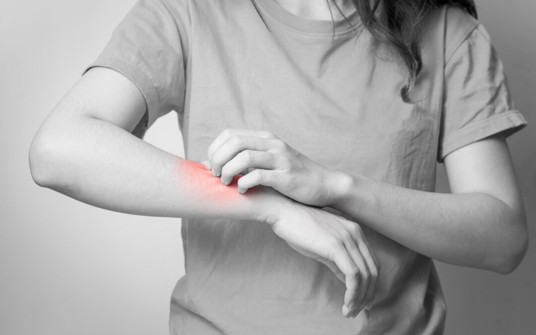 How Does AFC Treat Poison Ivy?